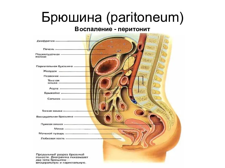 Брюшина (paritoneum) Воспаление - перитонит