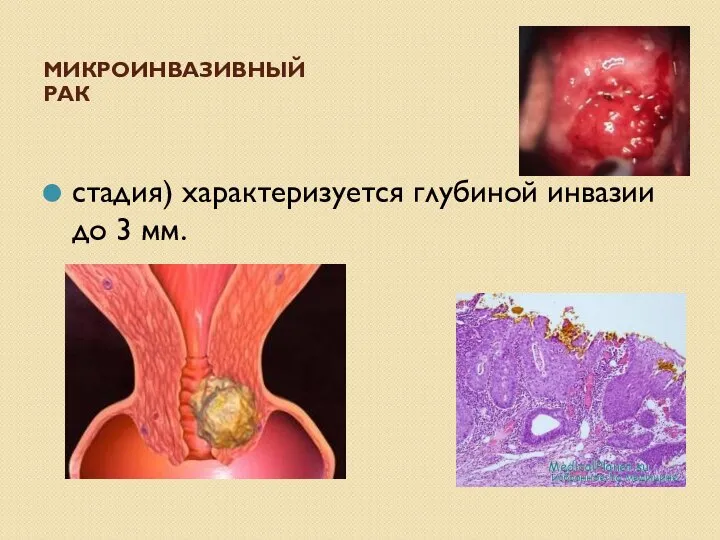 МИКРОИНВАЗИВНЫЙ РАК стадия) характеризуется глубиной инвазии до 3 мм.