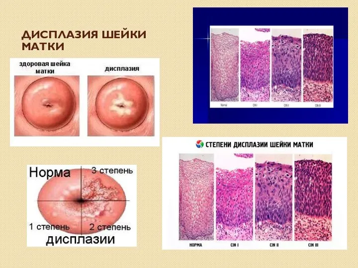 ДИСПЛАЗИЯ ШЕЙКИ МАТКИ