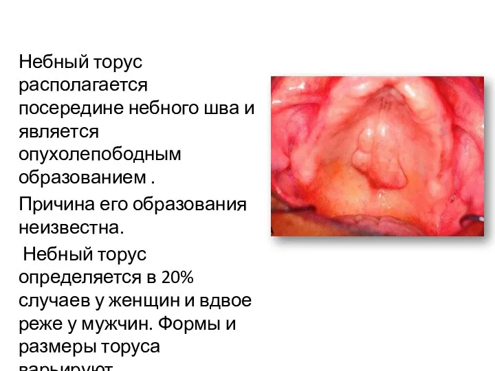 Небный торус располагается посередине небного шва и является опухолепободным образованием . Причина