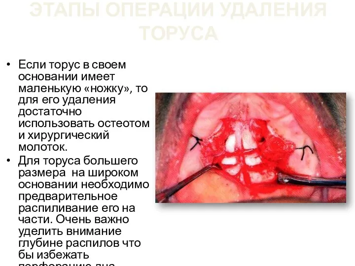 ЭТАПЫ ОПЕРАЦИИ УДАЛЕНИЯ ТОРУСА Если торус в своем основании имеет маленькую «ножку»,