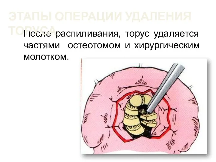 После распиливания, торус удаляется частями остеотомом и хирургическим молотком. ЭТАПЫ ОПЕРАЦИИ УДАЛЕНИЯ ТОРУСА