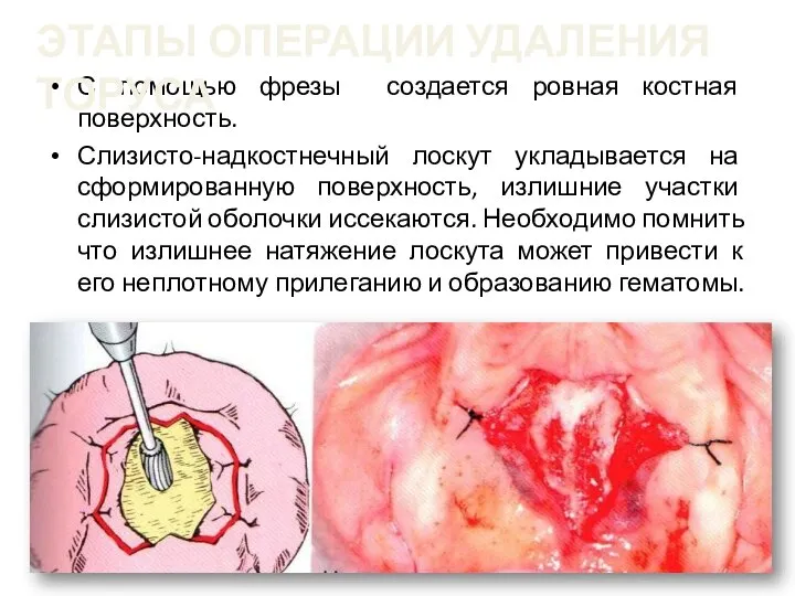 С помощью фрезы создается ровная костная поверхность. Слизисто-надкостнечный лоскут укладывается на сформированную