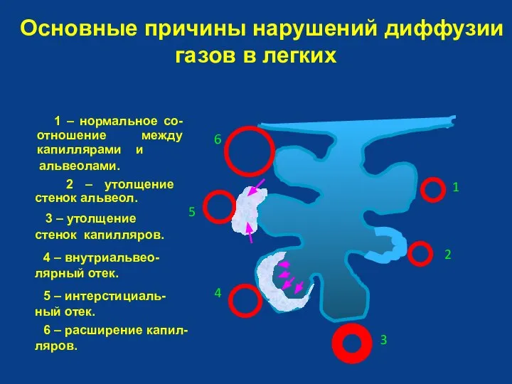 Основные причины нарушений диффузии газов в легких 1 – нормальное со-отношение между