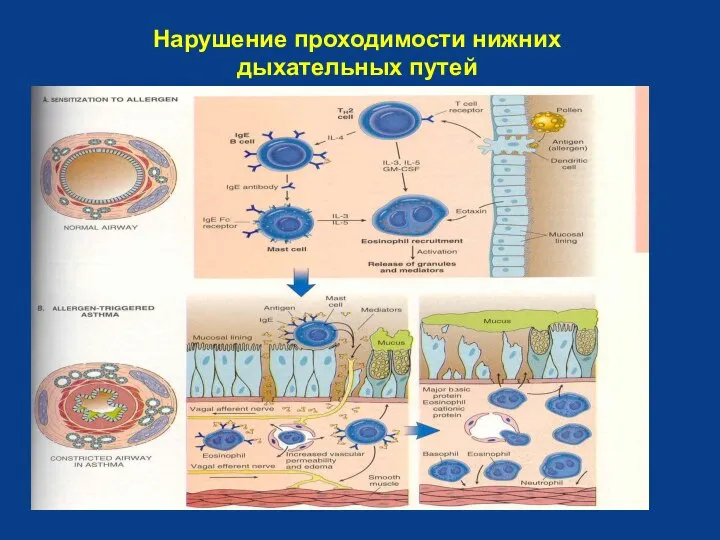 Нарушение проходимости нижних дыхательных путей