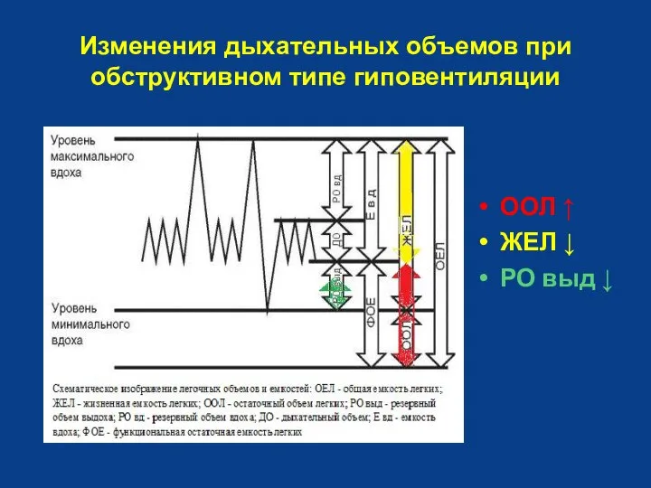 Изменения дыхательных объемов при обструктивном типе гиповентиляции ООЛ ↑ ЖЕЛ ↓ РО выд ↓