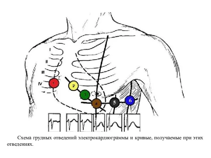 Схема грудных отведений электро­кардиограммы и кривые, получаемые при этих отведениях.