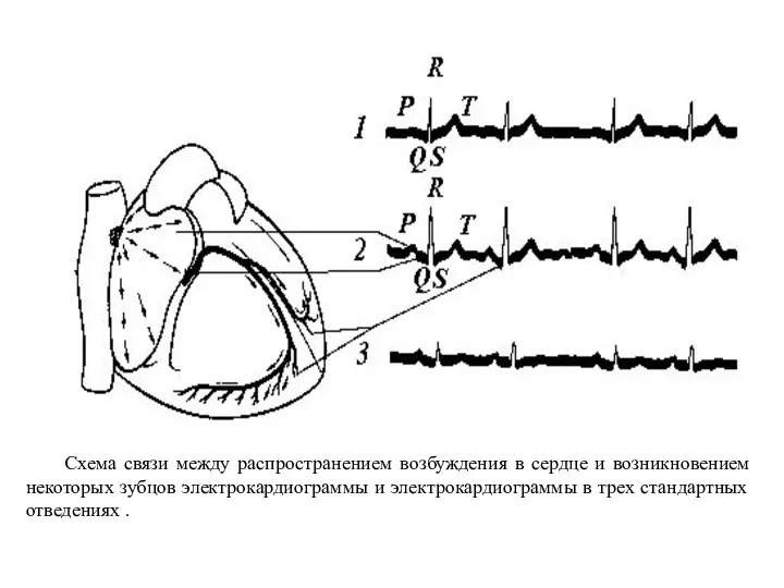 Схема связи между распространением возбуждения в сердце и возникновением некоторых зубцов электрокардиограммы