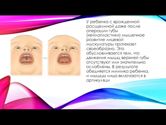 У ребенка с врожденной расщелиной даже после операции губы (хейлопластики) мышечное развитие