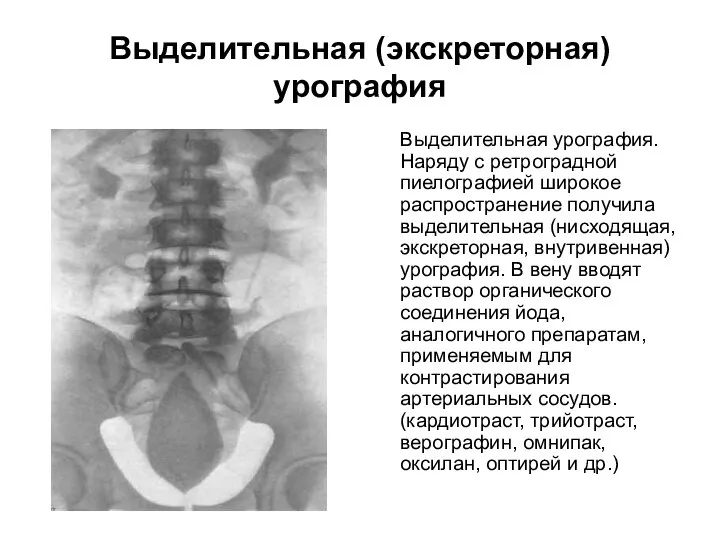 Выделительная (экскреторная) урография Выделительная урография. Наряду с ретроградной пиелографией широкое распространение получила