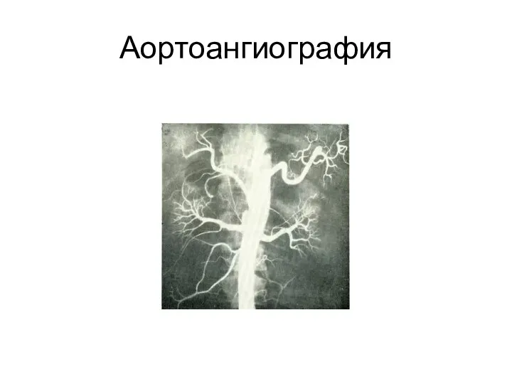 Аортоангиография