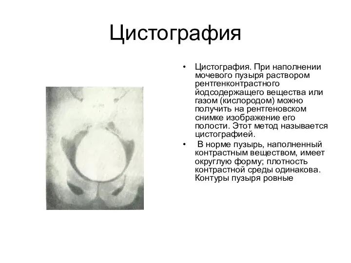 Цистография Цистография. При наполнении мочевого пузыря раствором рентгенконтрастного йодсодержащего вещества или газом