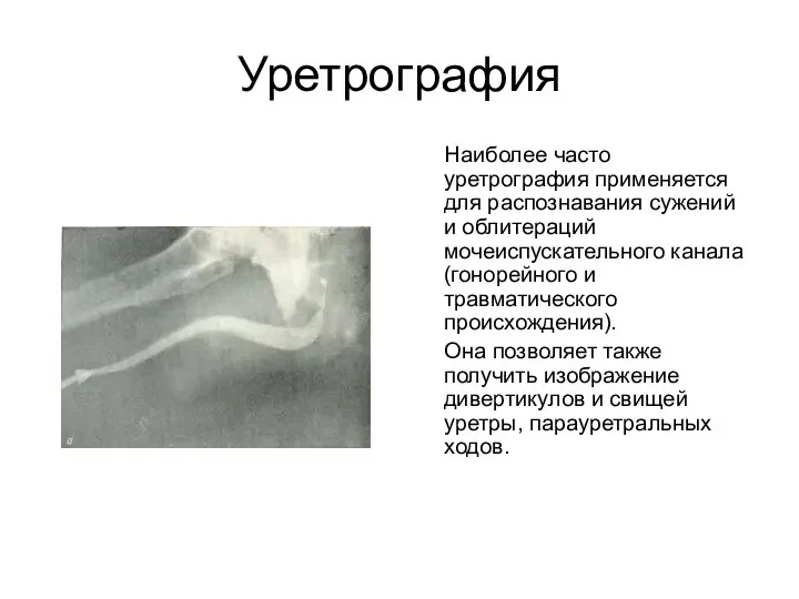 Уретрография Наиболее часто уретрография применяется для распознавания сужений и облитераций мочеиспускательного канала