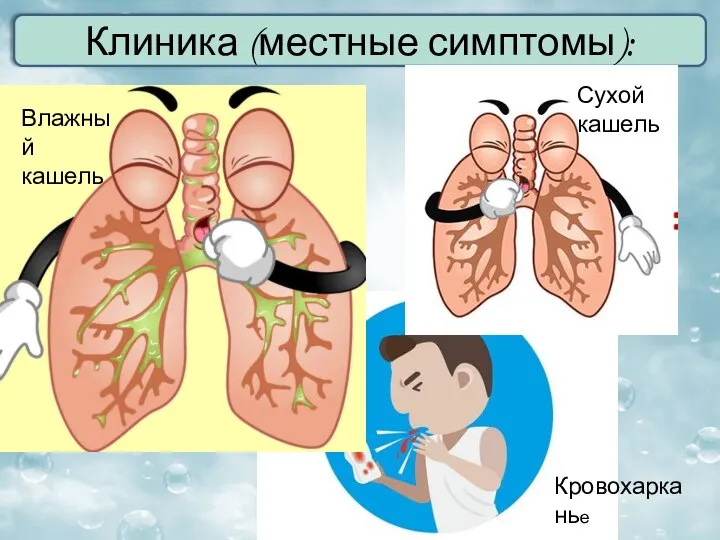 Клиника (местные симптомы): Сухой кашель Влажный кашель Кровохарканье