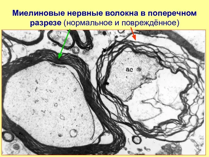 Миелиновые нервные волокна в поперечном разрезе (нормальное и повреждённое)
