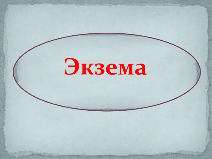 Экзема