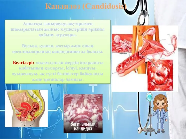 Кандидоз (Candidosis) Ашытқы саңырауқұлақтарымен шақырылатын жыныс мүшелерінің арнайы қабыну аурулары. Вульва, қынап,