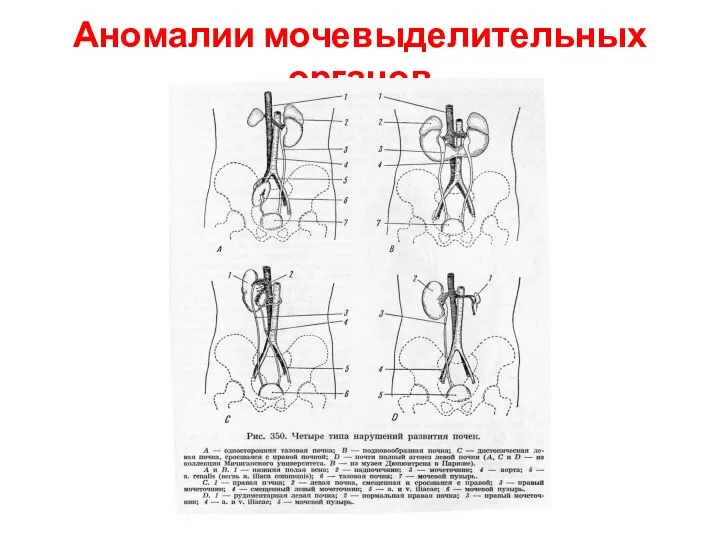 Аномалии мочевыделительных органов