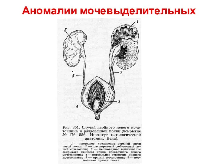 Аномалии мочевыделительных органов