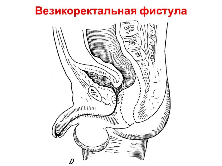 Везикоректальная фистула