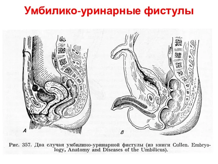 Умбилико-уринарные фистулы