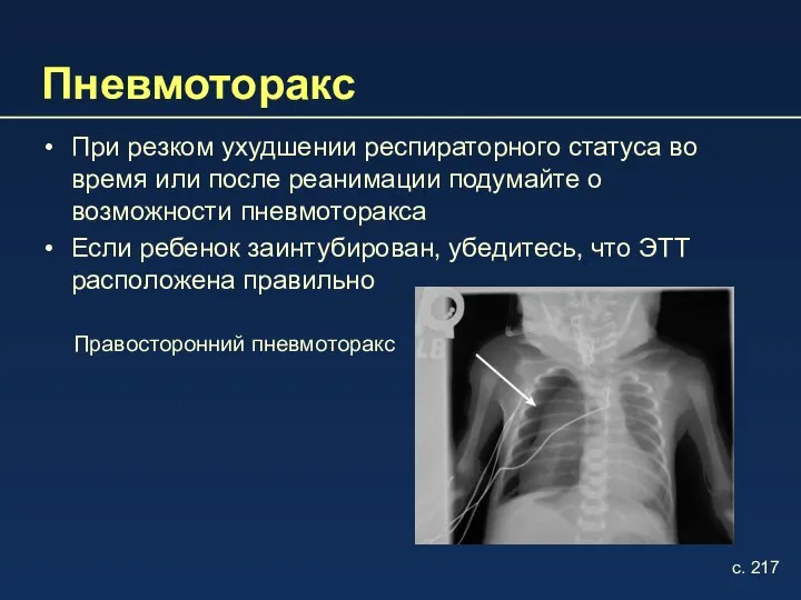 Пневмоторакс При резком ухудшении респираторного статуса во время или после реанимации подумайте