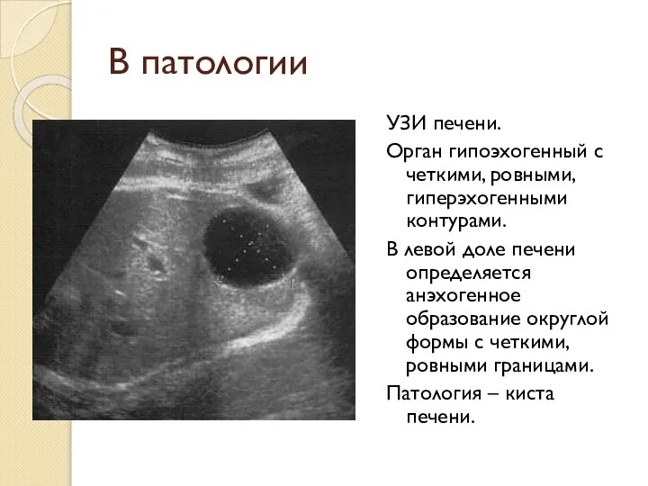 В патологии УЗИ печени. Орган гипоэхогенный с четкими, ровными, гиперэхогенными контурами. В