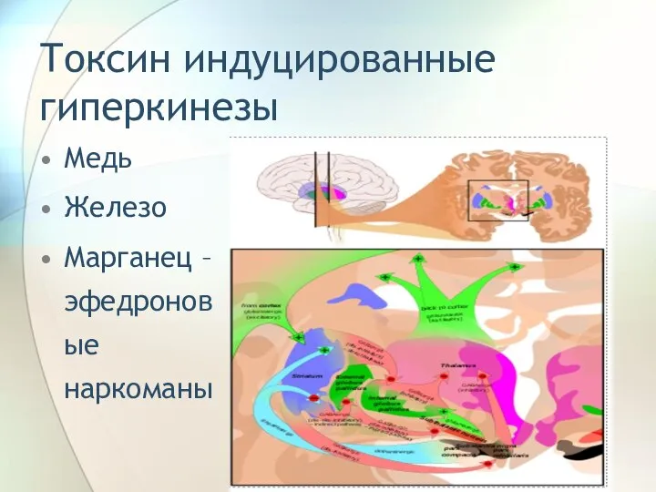 Токсин индуцированные гиперкинезы Медь Железо Марганец – эфедроновые наркоманы