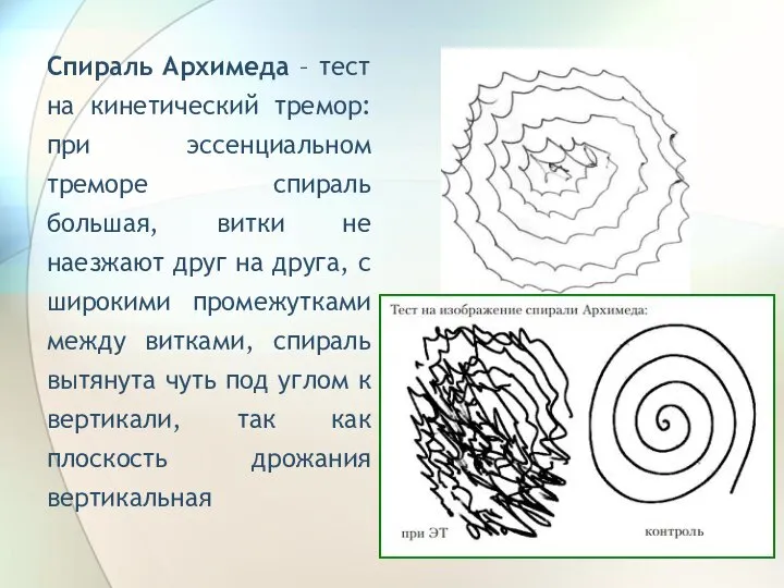 Спираль Архимеда – тест на кинетический тремор: при эссенциальном треморе спираль большая,