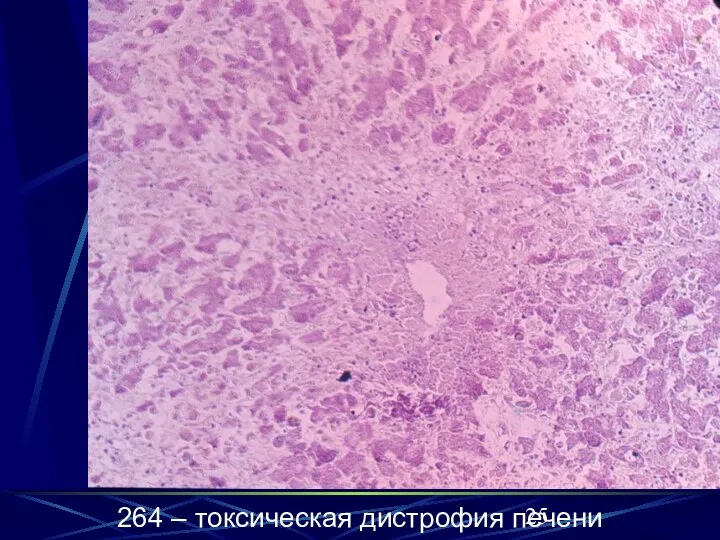 264 – токсическая дистрофия печени 264 – токсическая дистрофия печени