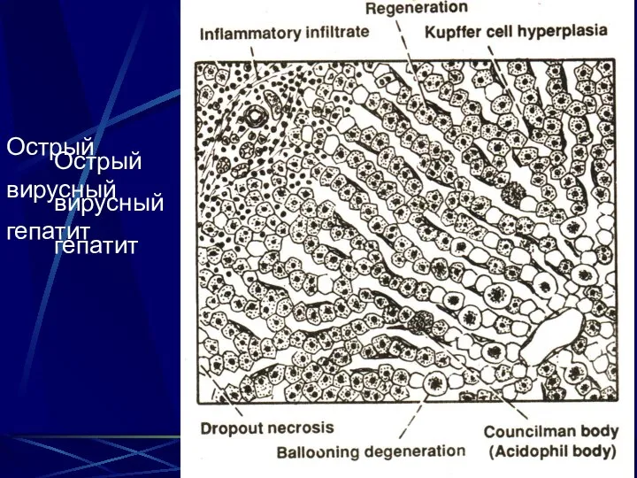 Острый вирусный гепатит Острый вирусный гепатит