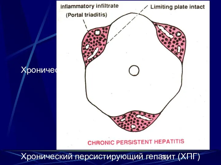 Хронический персистирующий гепатит (ХПГ) Хронический персистирующий гепатит (ХПГ)