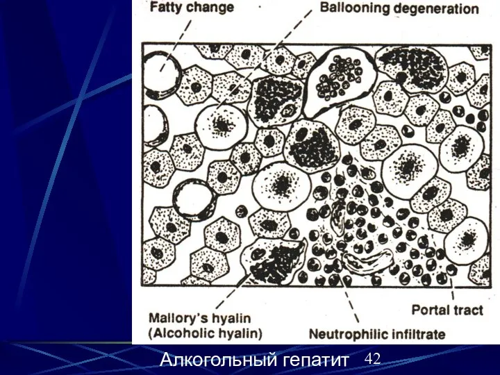 Алкогольный гепатит Алкогольный гепатит