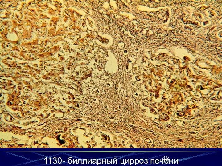 1130- биллиарный цирроз печени 1130- биллиарный цирроз печени