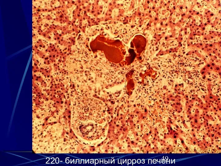 220- биллиарный цирроз печени 220- биллиарный цирроз печени