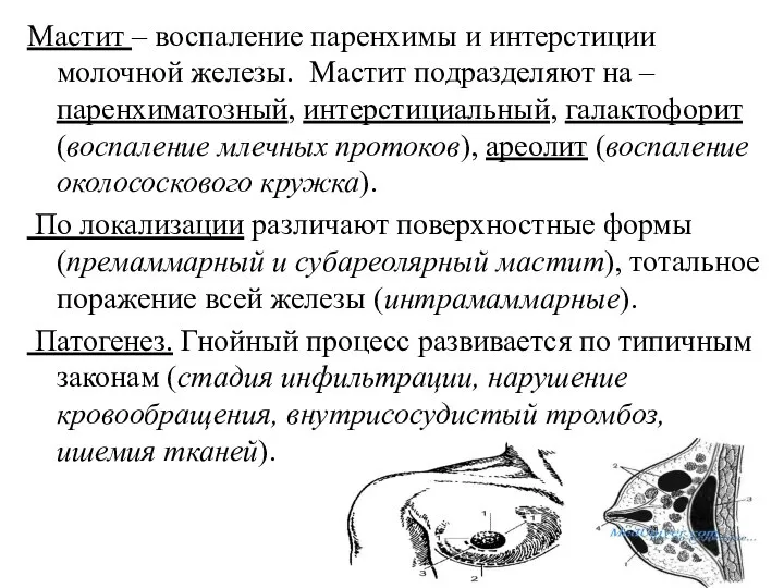 Мастит – воспаление паренхимы и интерстиции молочной железы. Мастит подразделяют на –