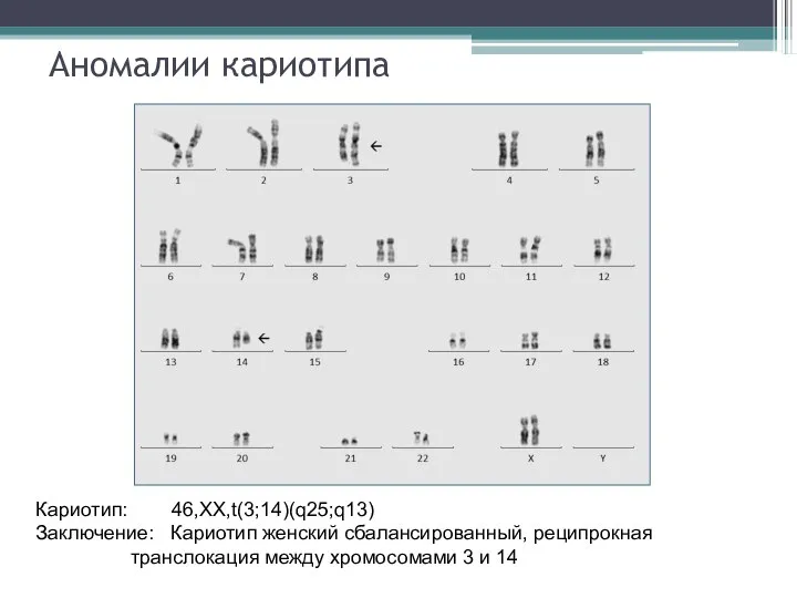 Аномалии кариотипа Кариотип: 46,XX,t(3;14)(q25;q13) Заключение: Кариотип женский сбалансированный, реципрокная транслокация между хромосомами 3 и 14