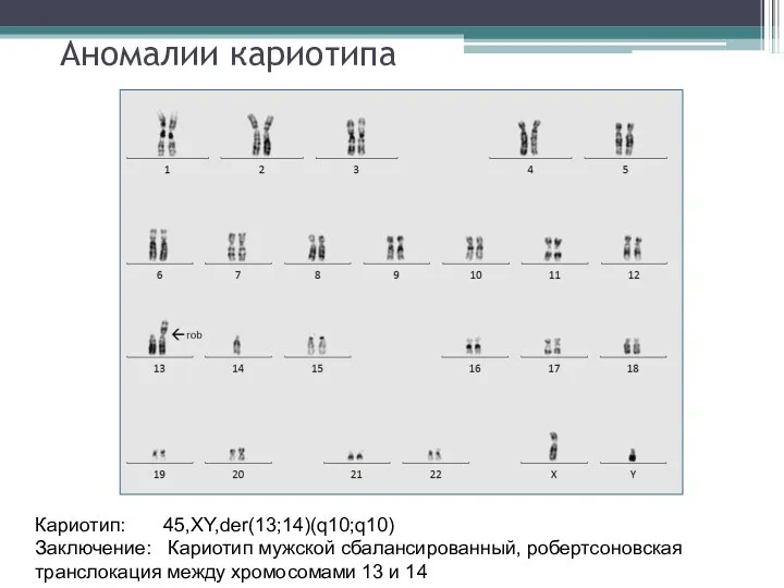 Аномалии кариотипа Кариотип: 45,XY,der(13;14)(q10;q10) Заключение: Кариотип мужской сбалансированный, робертсоновская транслокация между хромосомами 13 и 14