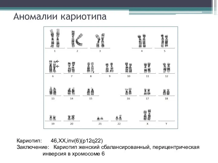 Аномалии кариотипа Кариотип: 46,XX,inv(6)(p12q22) Заключение: Кариотип женский сбалансированный, перицентрическая инверсия в хромосоме 6