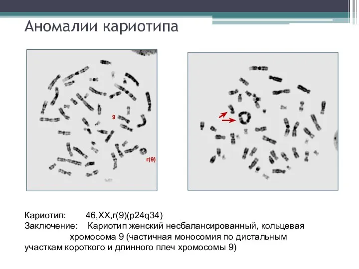 Аномалии кариотипа 9 r(9) Кариотип: 46,XX,r(9)(p24q34) Заключение: Кариотип женский несбалансированный, кольцевая хромосома