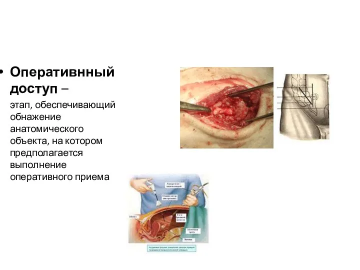 Оперативнный доступ – этап, обеспечивающий обнажение анатомического объекта, на котором предполагается выполнение оперативного приема