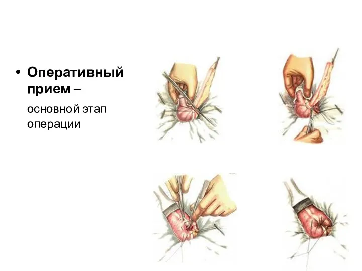 Оперативный прием – основной этап операции