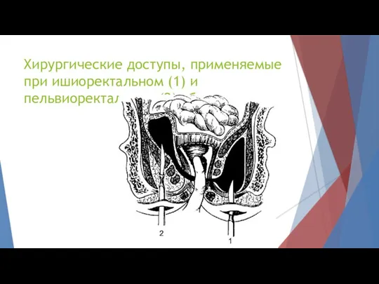 Хирургические доступы, применяемые при ишиоректальном (1) и пельвиоректальном (2) абсцессах.