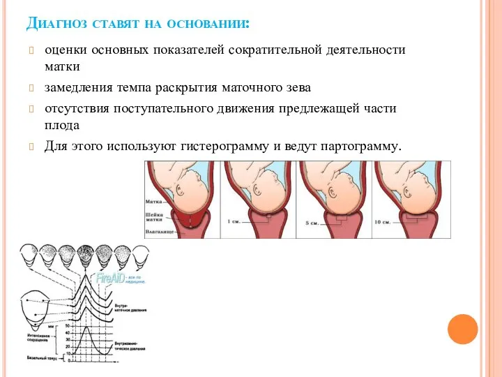 Диагноз ставят на основании: оценки основных показателей сократительной деятельности матки замедления темпа