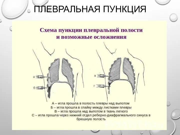 ПЛЕВРАЛЬНАЯ ПУНКЦИЯ