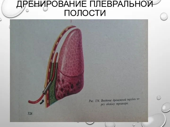 ДРЕНИРОВАНИЕ ПЛЕВРАЛЬНОЙ ПОЛОСТИ