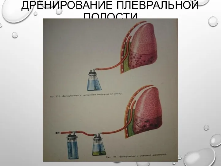 ДРЕНИРОВАНИЕ ПЛЕВРАЛЬНОЙ ПОЛОСТИ