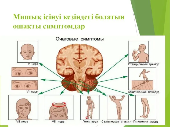 Мишық ісінуі кезіндегі болатын ошақты симптомдар