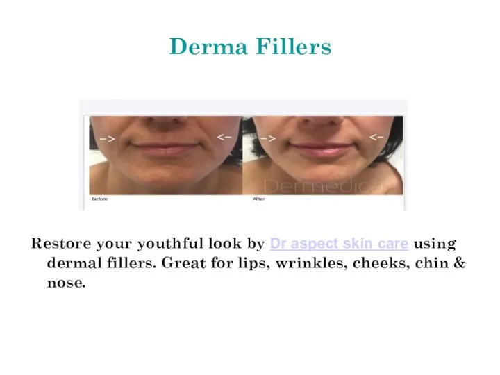 Derma Fillers Restore your youthful look by Dr aspect skin care using