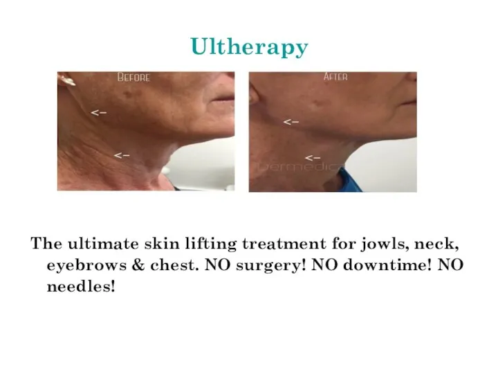 Ultherapy The ultimate skin lifting treatment for jowls, neck, eyebrows & chest.